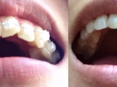 Before and after braces